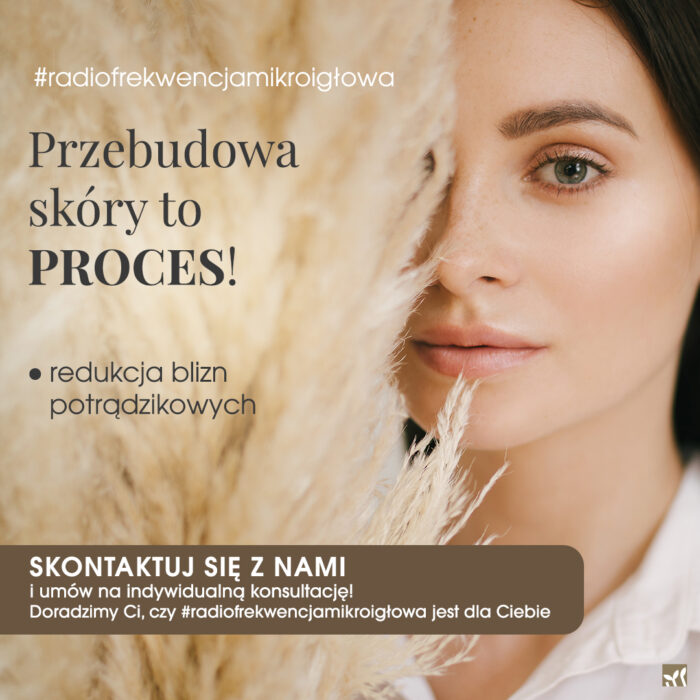 Vivace_1080x1080_3 Radiofrekwencja mikroigłowa