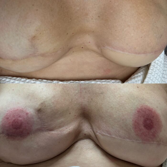 pigmentacja po mastektomii szczecin pigmentacja po mastektomii szczecin