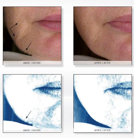 ENDERMOLOGIA TWARZY - MASAŻ szczecin ENDERMOLOGIA TWARZY - MASAŻ szczecin