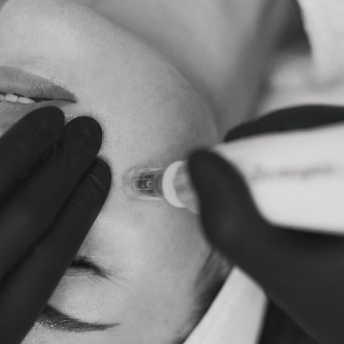 BW_1389 Mezoterapia mikroigłowa