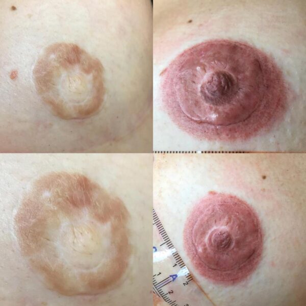 pigmentacja medyczna sutka po mastektomii szczecin pigmentacja medyczna sutka po mastektomii szczecin