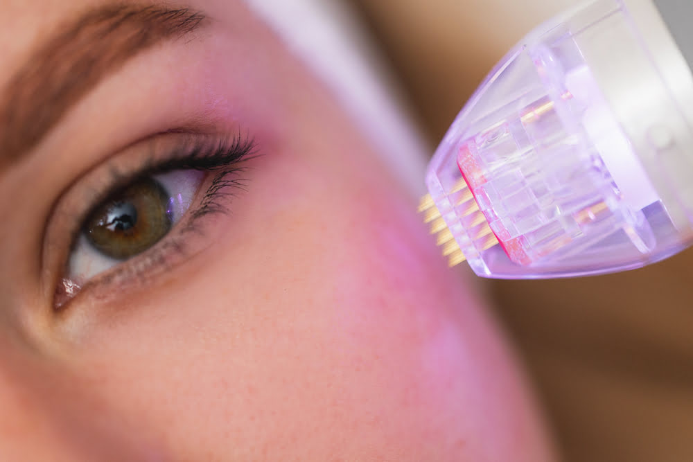 usuwanie przebarwień na twarzy szczecin