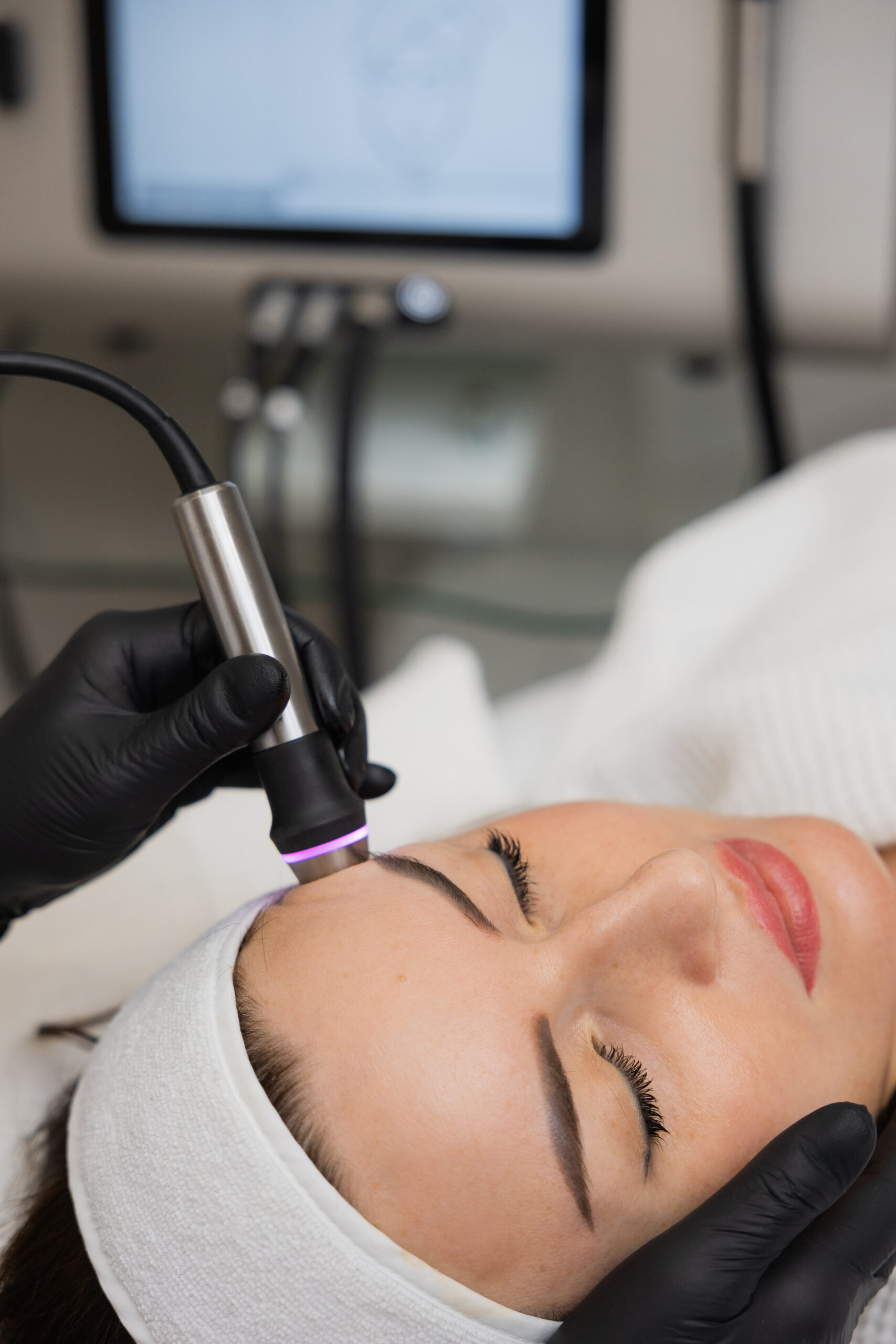 IMG_1497 Mikrodermabrazja SkinPeeler