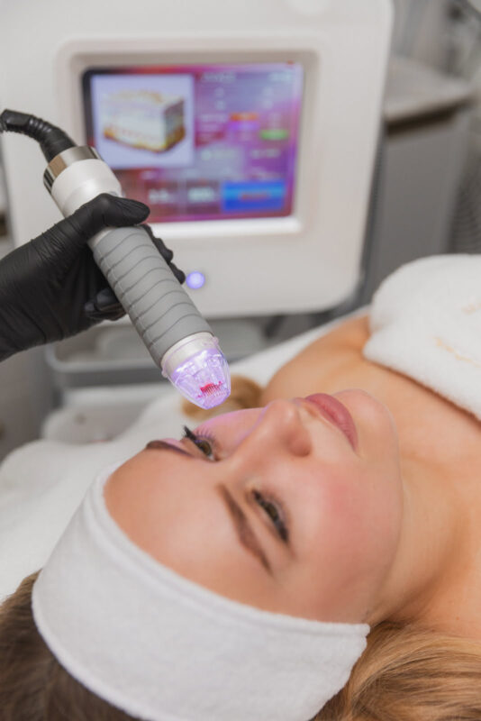 Czy warto wykonywać radiofrekwencję mikroigłową?